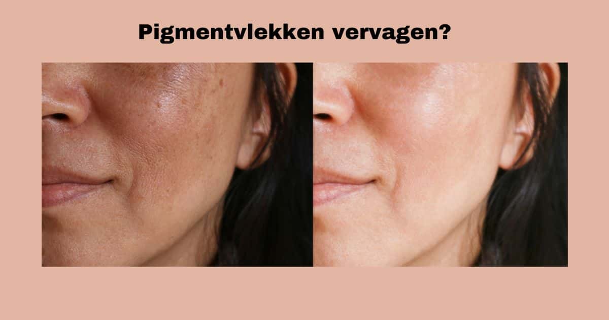 Wat helpt tegen pigmentvlekken? De beste producten en tips